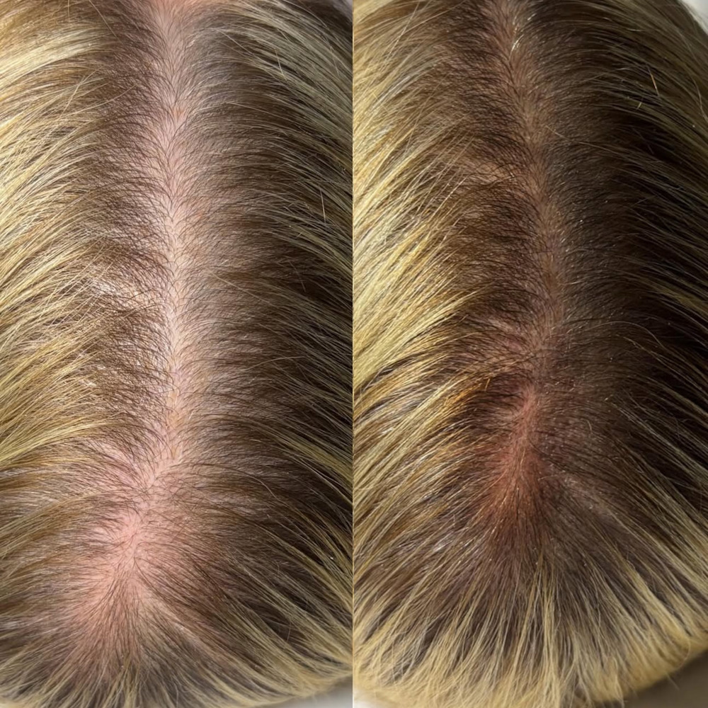 Лечение выпадения волос